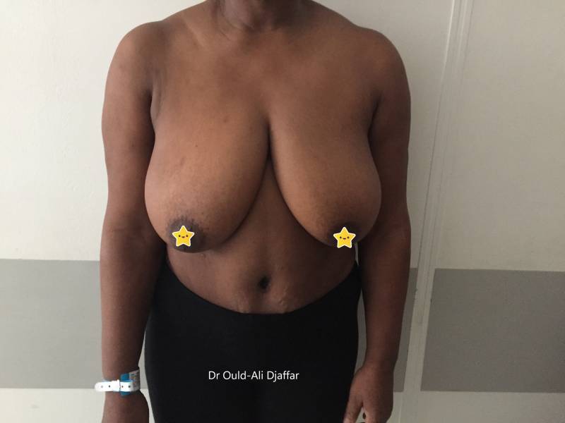 Éliminer le mal de dos lié à une hypertrophie mammaire avec la chirurgie esthétique, Clamart 92140